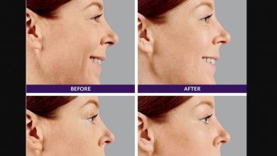 Juvederm treatment