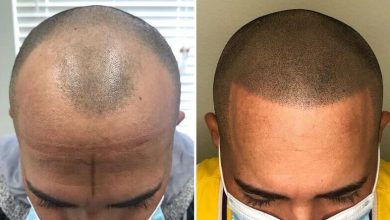scalp micropigmentation- Know the Benefits and Risks of Scalp Micropigmentation
