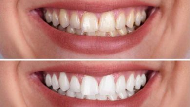 teeth whitening