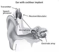 Cochlear Implant