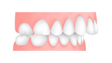 overjet vs overbite