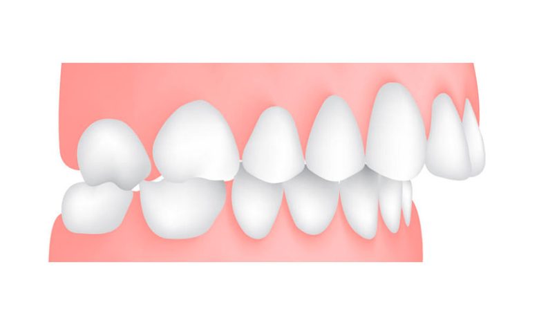 overjet vs overbite