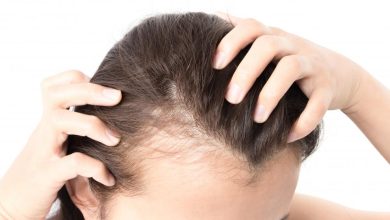 Female Pattern Hair Loss - Causes, Symptoms, Treatment Options