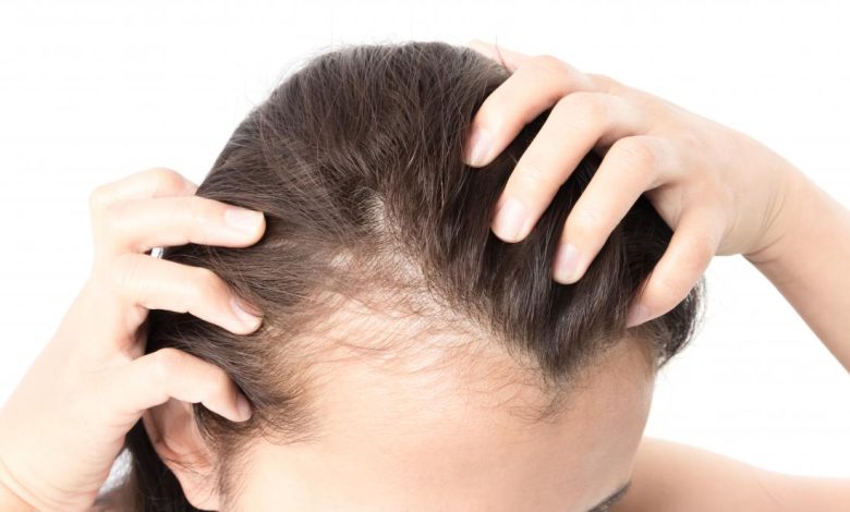 Female Pattern Hair Loss - Causes, Symptoms, Treatment Options