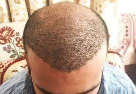 hair transplant