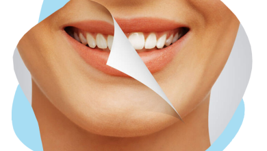 teeth whitening Surrey