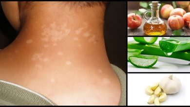 Natural Tips for Tinea Versicolor and Supporting Healthy Skin
