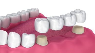 dental implants near me