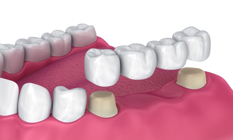 dental implants near me