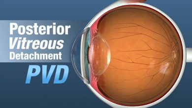 Posterior Vitreous Detachment featured image