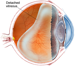 Posterior Vitreous Detachment Image