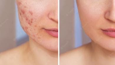 Laser Acne Scar Treatment