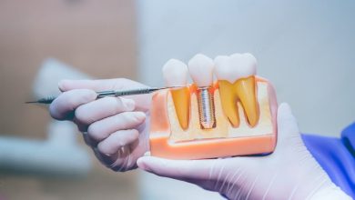dental implants in London