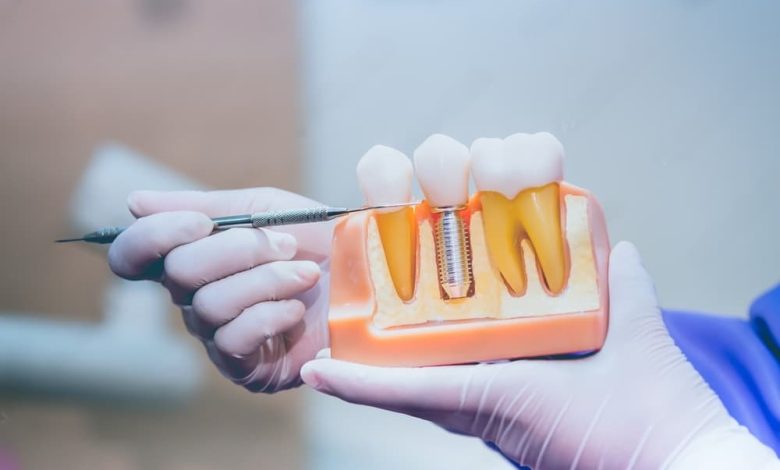 dental implants in London